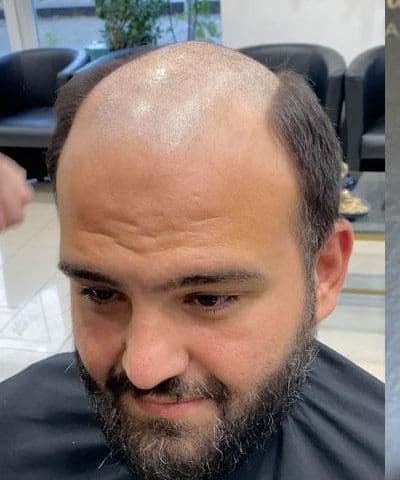 Advanced Crown Baldness to Full Density Volume - Before transformation