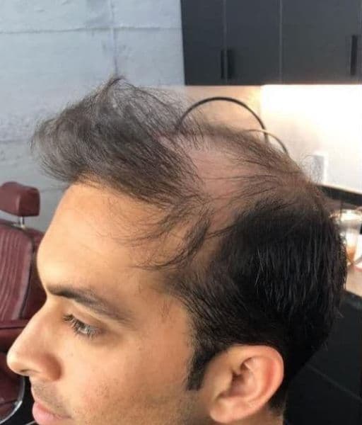 Receding Frontal Temples to Textured Modern Fade - Before transformation